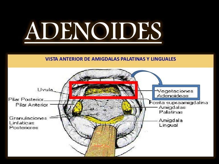 Vegetaciones en adultos jovenes